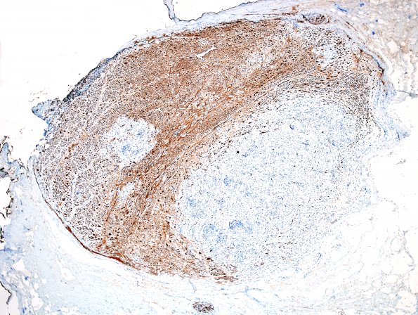 1E4 Schwannoma, plexiform, NF2 patient (Case 1) NF 10