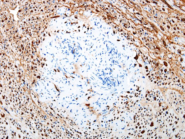 1E5 Schwannoma, plexiform, NF2 patient (Case 1) NF 7