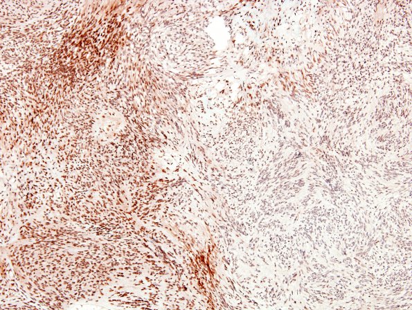 1F2 Schwannoma, plexiform, NF2 patient (Case 1) BAF47 4