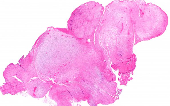 2A4 Schwannoma, plexiform (Case 2) Slide D1 H&E 2X