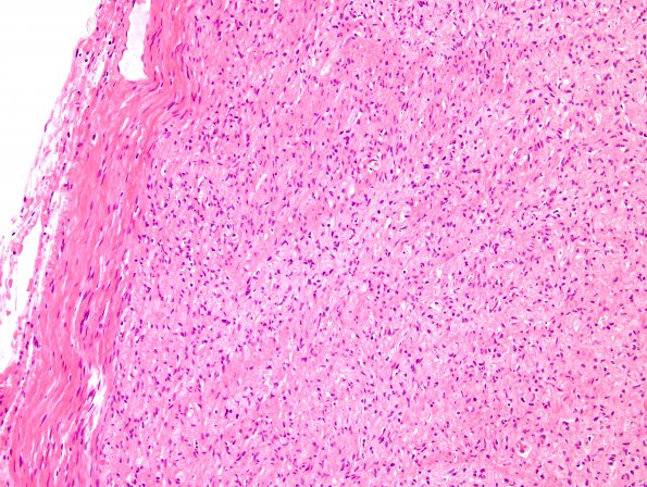 2A6 Schwannoma, plexiform (Case 2) H&E 1.jpg