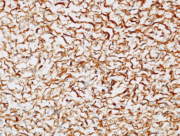 2C8 Schwannoma, plexiform (Case 2) Slide D1 Coll IV 40X.jpg