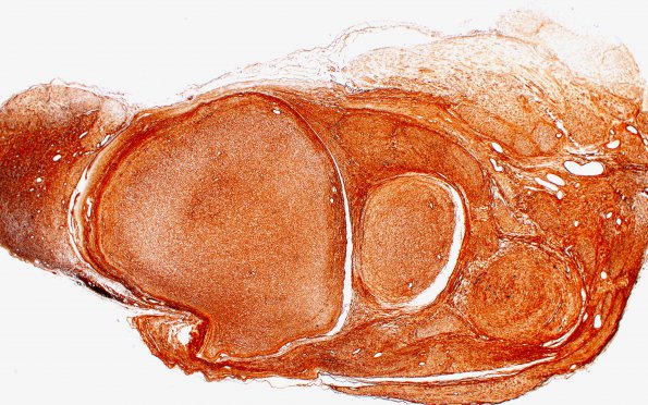 2C1 (Case 2) B1 Coll IV 2X