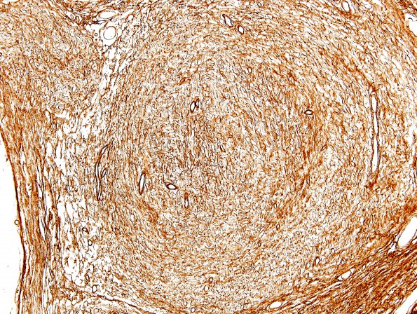 2C6 Schwannoma, plexiform (Case 2) Coll IV 3.jpg