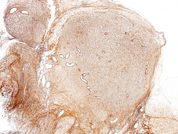 2C7 Schwannoma, plexiform (Case 2) Slide D1 1 Coll IV 4X.jpg