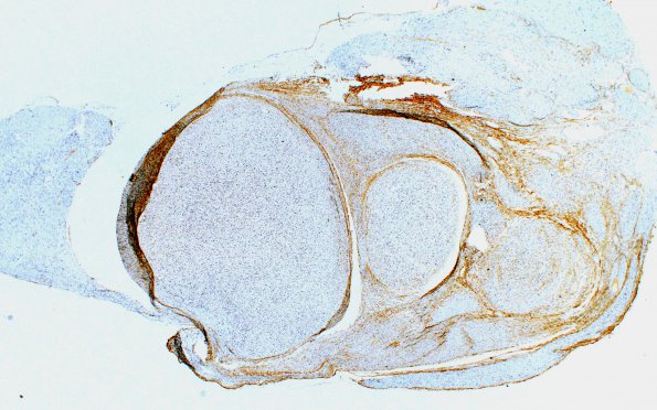 2E1 (Case 2) B1 EMA 2XA