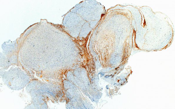 2E2 Schwannoma, plexiform (Case 2) Slide D1 EMA 2X