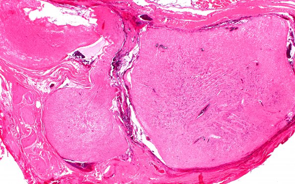 3A2 Schwannoma, plexiform (Case 3) B4 H&E 2X