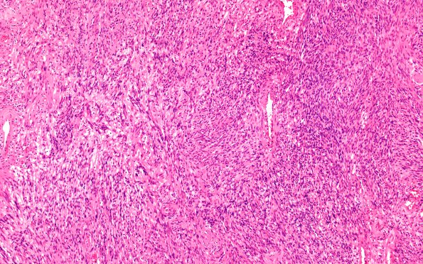 3A5 Schwannoma, plexiform (Case 3) B3 H&E 10X