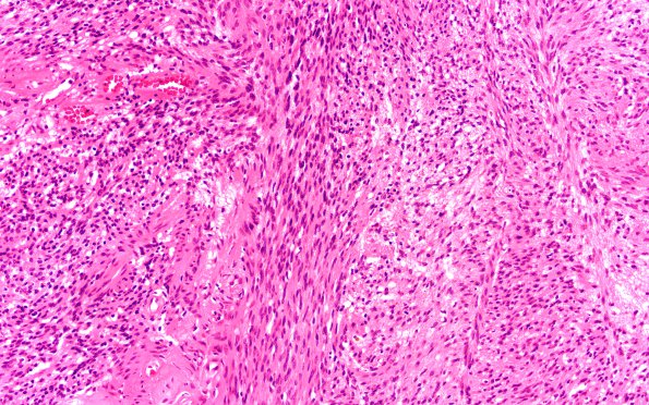 3A6 Schwannoma, plexiform (Case 3) B3 H&E 20X 2