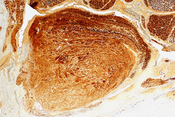 3B2 Schwannoma, plexiform (Case 3) B2 S100 4X