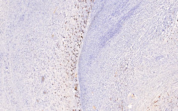 3C2 Schwannoma, plexiform (Case 3) B2 NF 4X 3