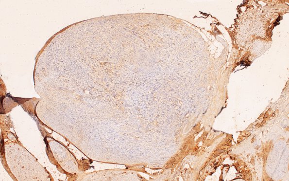 3D2 Schwannoma, plexiform (Case 3) B2 EMA 4X 3