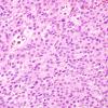 10A2 Psammomatous Melanotic Schwannoma (Case 10) H&E 2