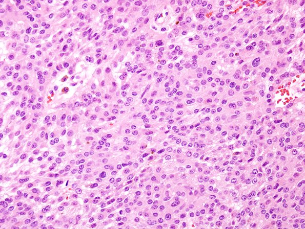 10A2 Psammomatous Melanotic Schwannoma (Case 10) H&E 2