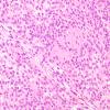 10A3 Psammomatous Melanotic Schwannoma (Case 10) H&E 13