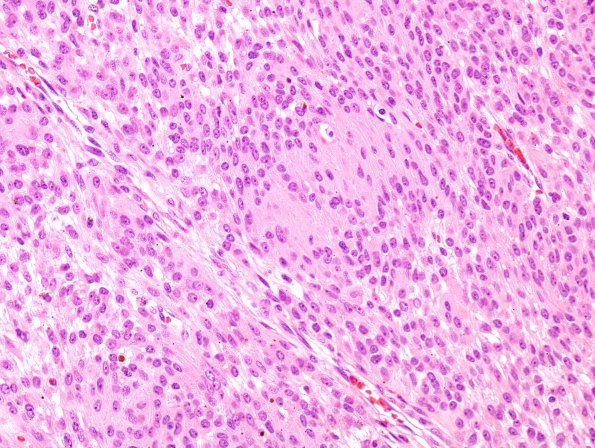 10A3 Psammomatous Melanotic Schwannoma (Case 10) H&E 13