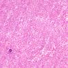 10A4 Psammomatous Melanotic Schwannoma (Case 10) H&E 10A