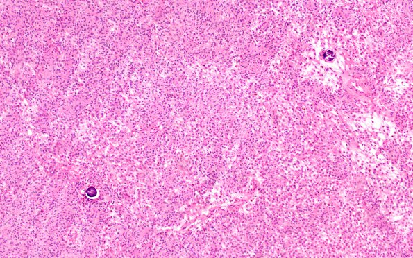 10A4 Psammomatous Melanotic Schwannoma (Case 10) H&E 10A