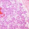 10A5 Psammomatous Melanotic Schwannoma (Case 10) H&E 5