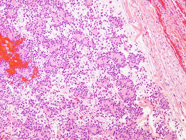 10A5 Psammomatous Melanotic Schwannoma (Case 10) H&E 5