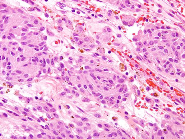 10A6 Psammomatous Melanotic Schwannoma (Case 10) H&E 6