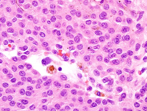 10A7 Psammomatous Melanotic Schwannoma (Case 10) H&E 100X 2