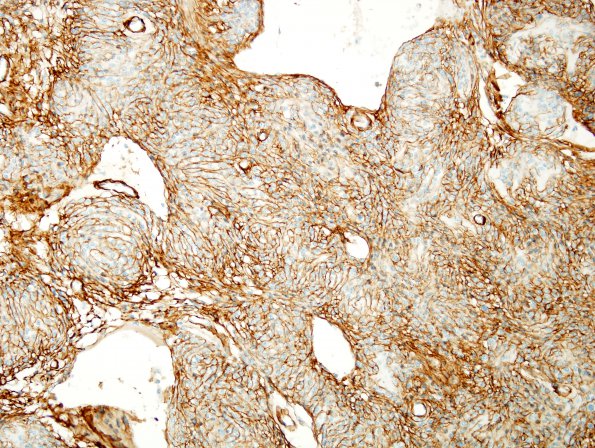 10B4 Psammomatous Melanotic Schwannoma (Case 10) Coll IV 2