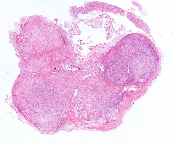 11A1 Schwannoma (Case 11) H&E 2