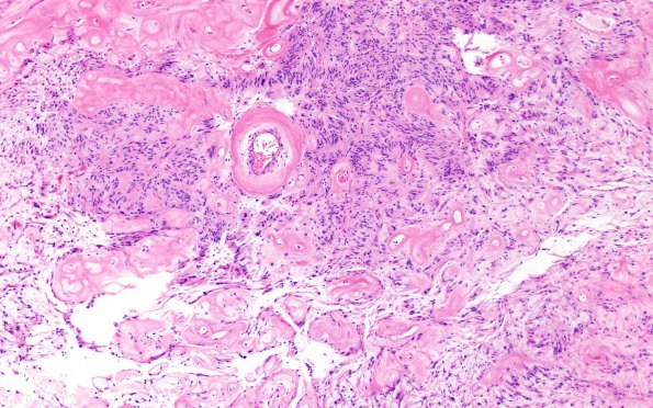 11A2 Schwannoma (Case 11) H&E 3