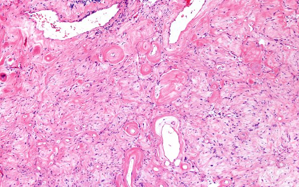 11A3 Schwannoma (Case 11) H&E 4