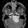 12A Ependymoma, meningioma, Schwannoma in NF2 (Case 12) T1W 3 - Copy