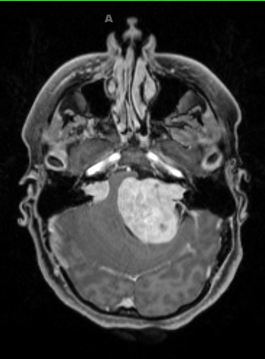 12A Ependymoma, meningioma, Schwannoma in NF2 (Case 12) T1W 3 - Copy