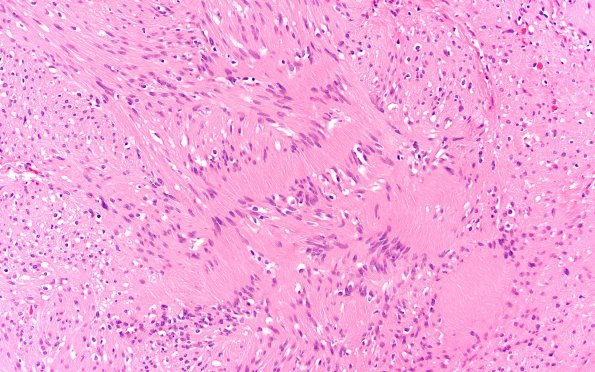 12B Ependymoma, meningioma, Schwannoma in NF2 (Case 12) 20X 2