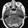 13A1 Meningiomas, Schwannomas (NF2, Case 13) T1 W 4 - Copy