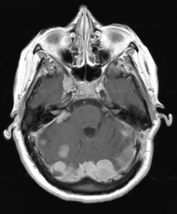 13A1 Meningiomas, Schwannomas (NF2, Case 13) T1 W 4 - Copy