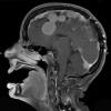 13A2 Meningiomas, Schwannomas (NF2, Case 13) T1 W 9 - Copy