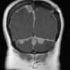 13A3 Meningiomas, Schwannomas (NF2, Case 13)  T1 W 6 - Copy