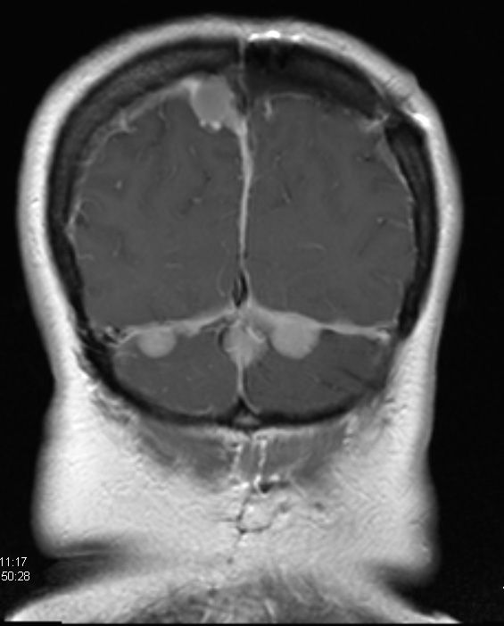 13A3 Meningiomas, Schwannomas (NF2, Case 13)  T1 W 6 - Copy