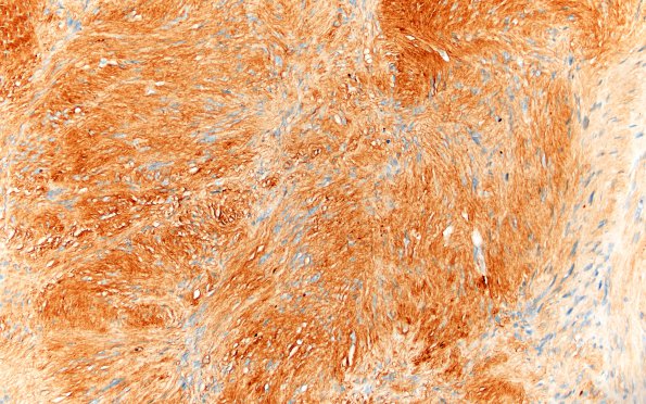 13B Meningiomas, Schwannomas (NF2, Case 13) Coll IV 20X