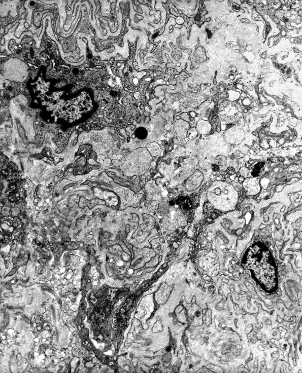 14A1 Schwannoma (Case 14) EM 3 - Copy