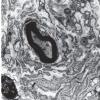 14A2 Schwannoma (Case 14) EM 4 - Copy