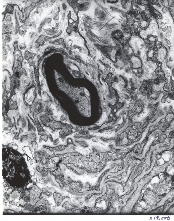 14A2 Schwannoma (Case 14) EM 4 - Copy