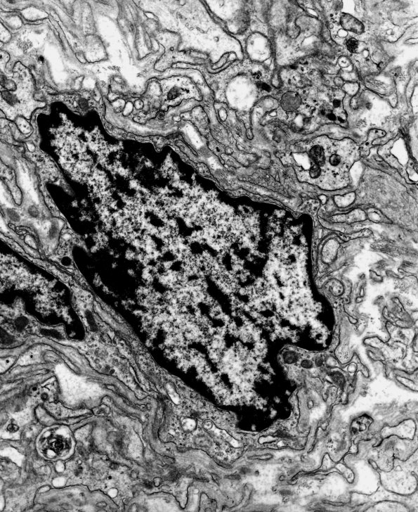 14A3 Schwannoma (Case 14) EM 1 - Copy