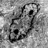 14A4 Schwannoma (Case 14) EM 2 - Copy