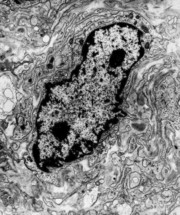 14A4 Schwannoma (Case 14) EM 2 - Copy