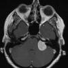 15A1 Schwannoma (Case 15) T1 W 2 - Copy