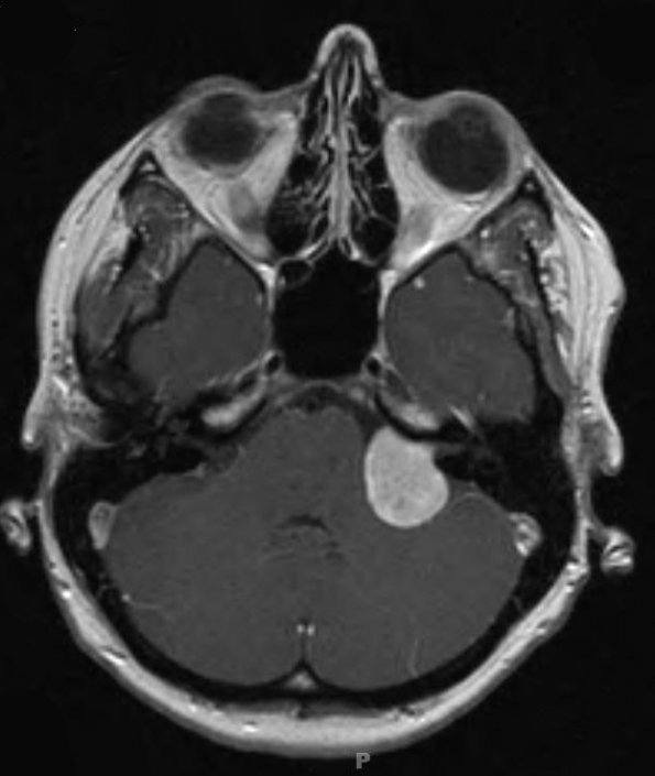 15A1 Schwannoma (Case 15) T1 W 2 - Copy