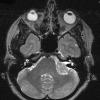 15A2 Schwannoma (Case 15) T2 W 1 - Copy