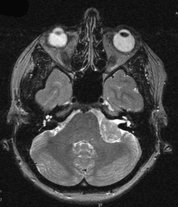 15A2 Schwannoma (Case 15) T2 W 1 - Copy